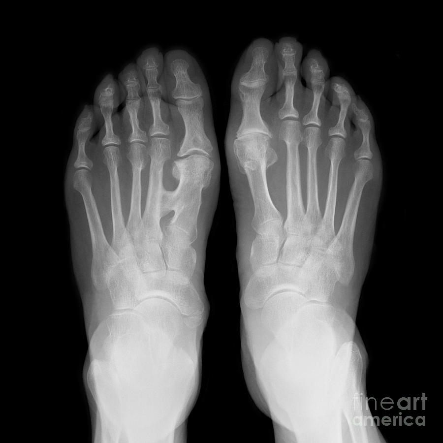 Fused Metatarsals, X-ray Photograph by Science Photo Library | Fine Art ...