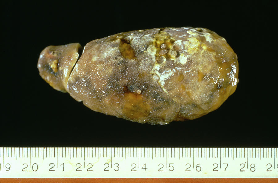Gallstone Photograph by Cnri/science Photo Library