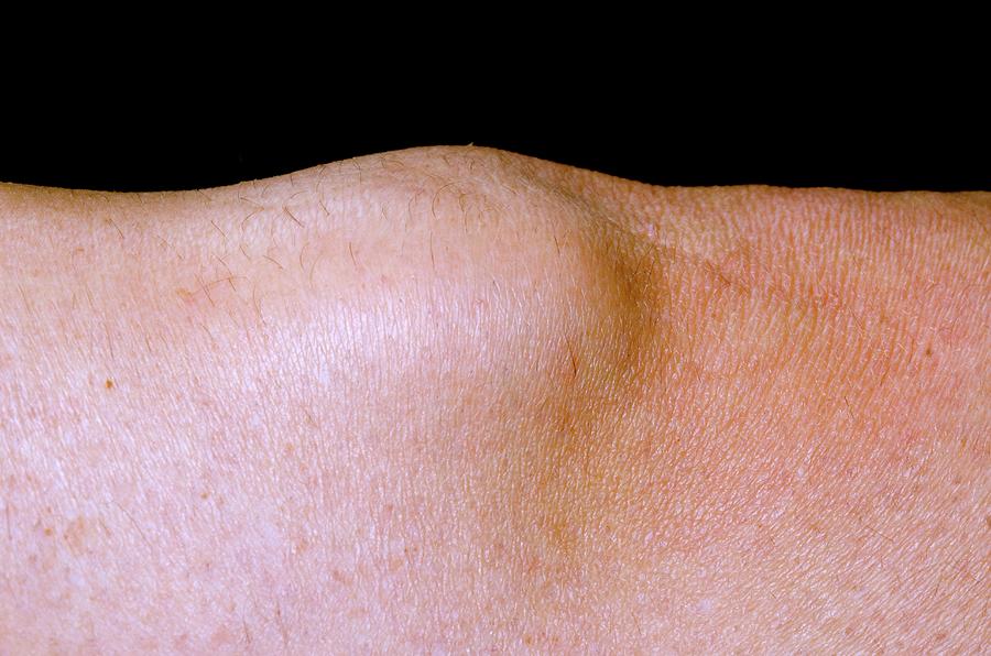 Ganglion Over The Knee Photograph by Dr P. Marazzi/science Photo Library