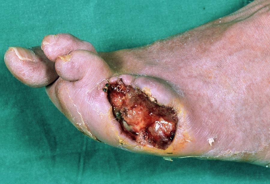 Gangrenous Foot Ulcer Photograph by Eamonn Mcnulty/science Photo Library