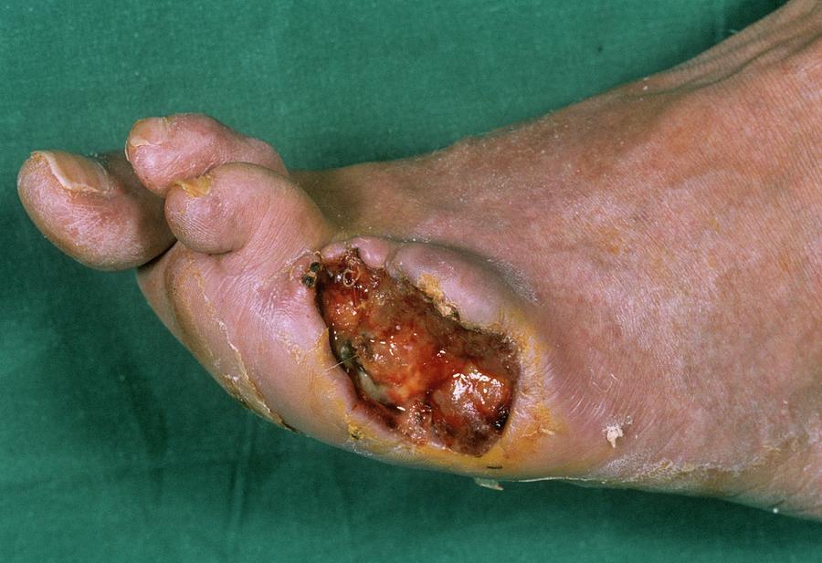 Gangrenous Toe In Diabetes Photograph by Photo-vision - Cnri/science Photo Library