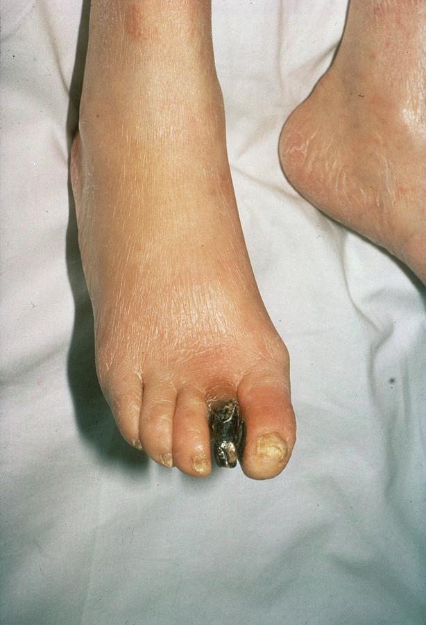 Gangrenous Toe In Diabetes Photograph by St Bartholomew Hospital/science Photo Library