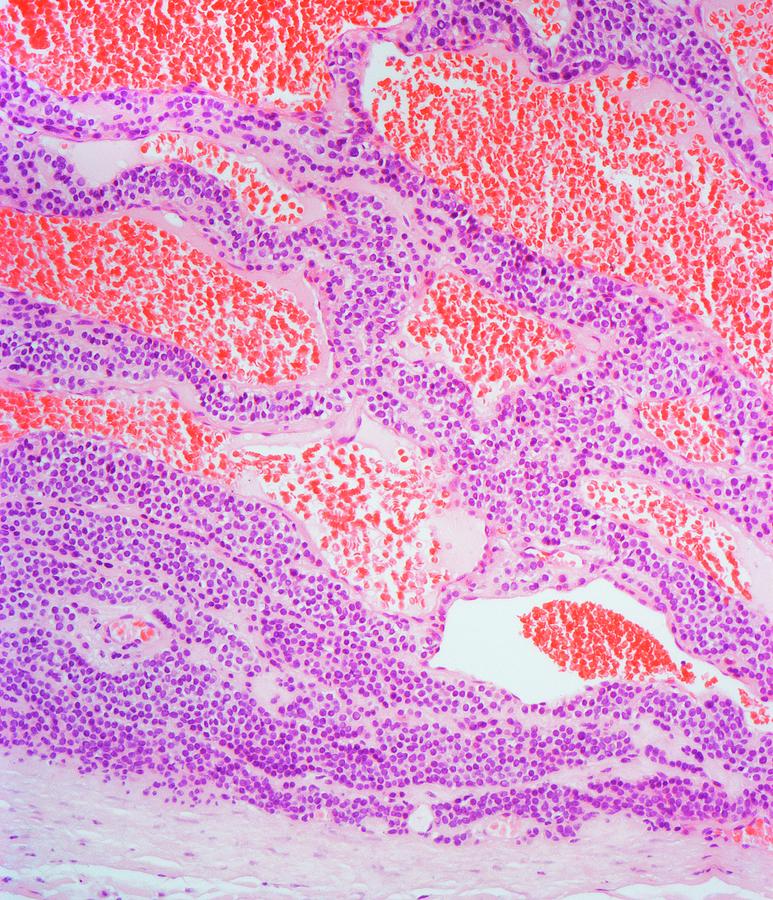 Healthcare Photograph - Gastric Glomus Tumour by Steve Gschmeissner