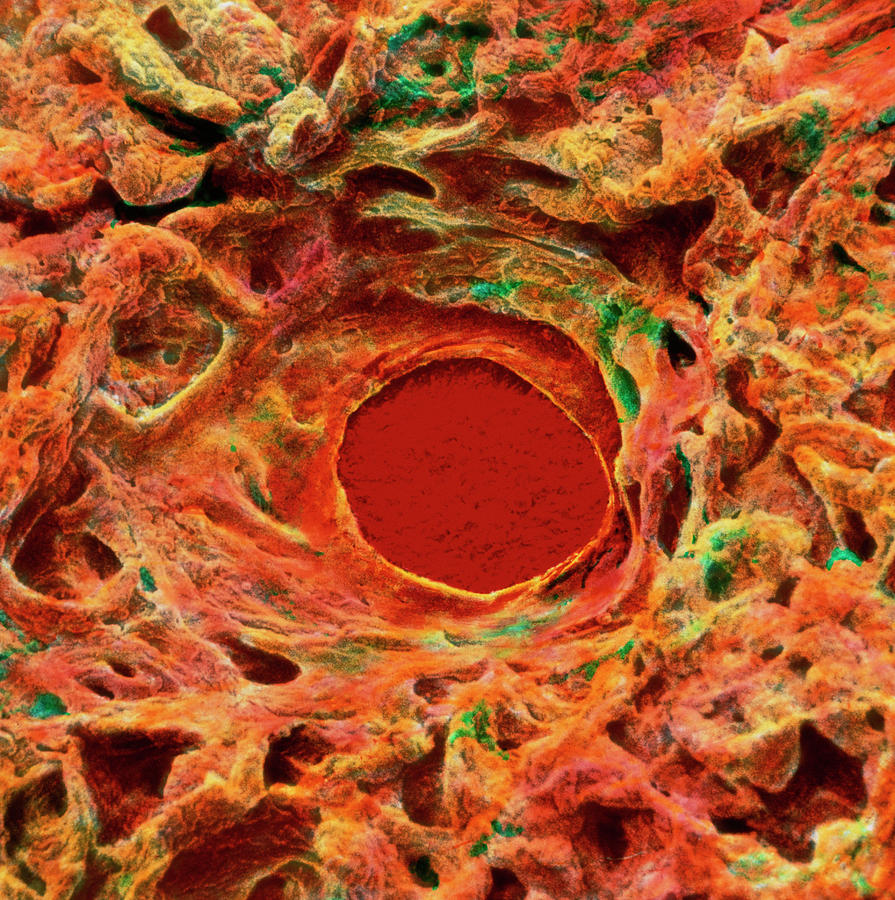 gastric-ulcer-photograph-by-prof-j-james-science-photo-library-fine