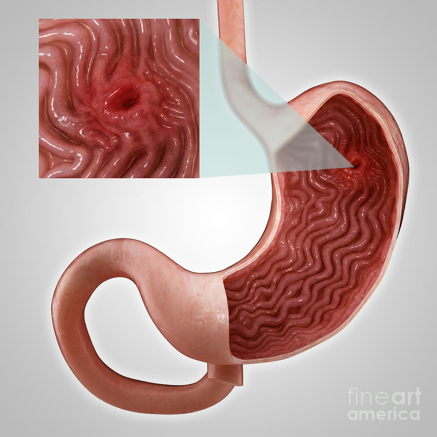 Grey Background Photograph - Gastric Ulcer by Science Picture Co