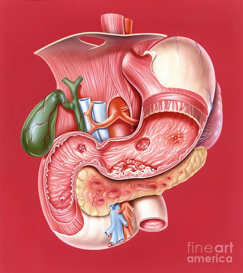 Peptic Ulcer Photograph - Gastrointestinal Disorders, Artwork by John Bavosi