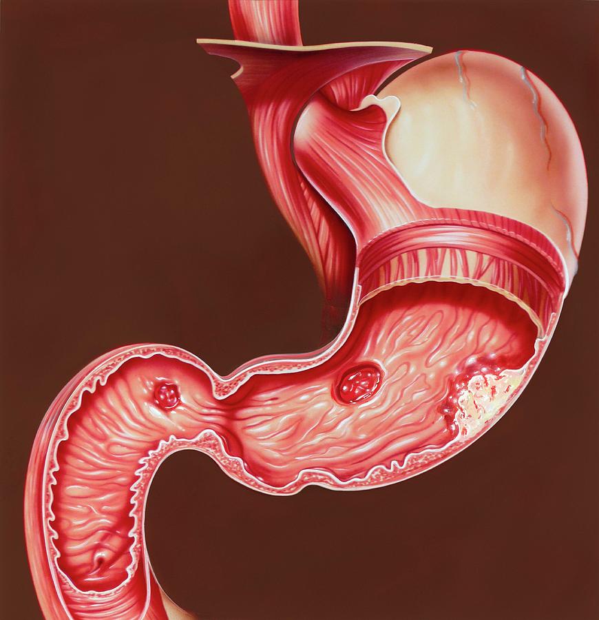 Gastrointestinal Disorders by John Bavosi/science Photo Library 