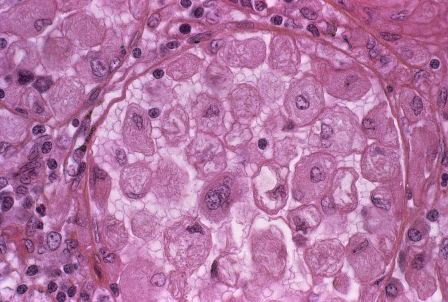 Gauchers Disease Photograph by Cnri/science Photo Library