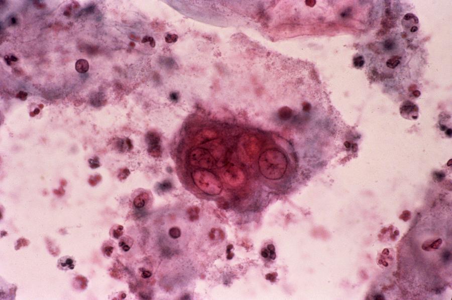 genital-herpes-photograph-by-cnri-science-photo-library-pixels