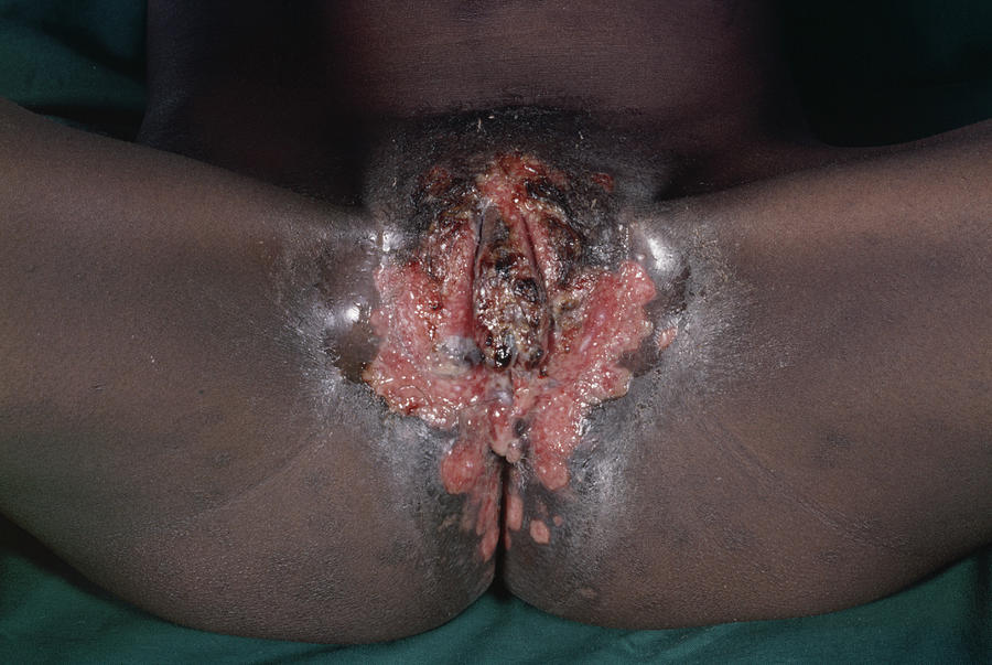 Medicine Photograph - Genital Herpes In Female Aids Patient by Dr M.a. Ansary/science Photo Library