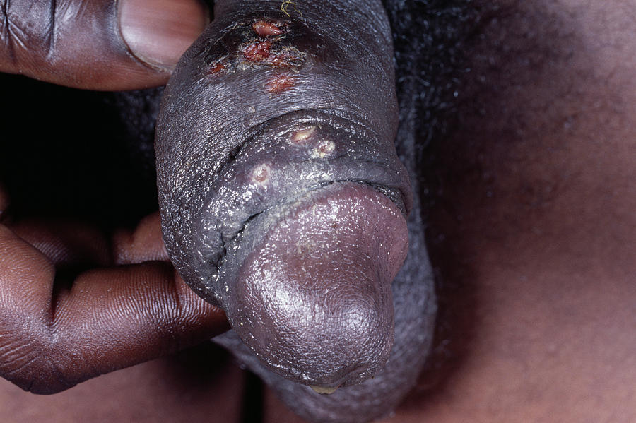 Medicine Photograph - Genital Herpes Ulcers by Dr M.a. Ansary/science Photo Library