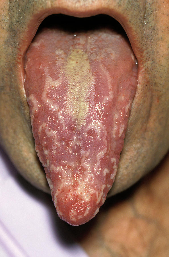 Geographic Tongue Photograph by Dr M.a. Ansary/science Photo Library