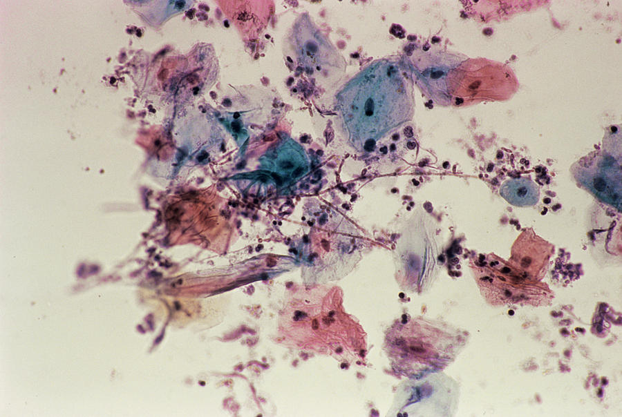 Geotrichosis Fungal Infection Photograph by Cnri/science Photo Library ...