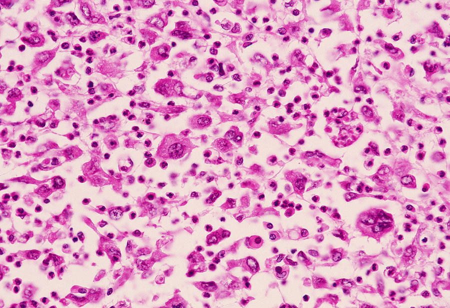 Giant Cell Carcinoma Lung Cancer Photograph by Michael Abbey