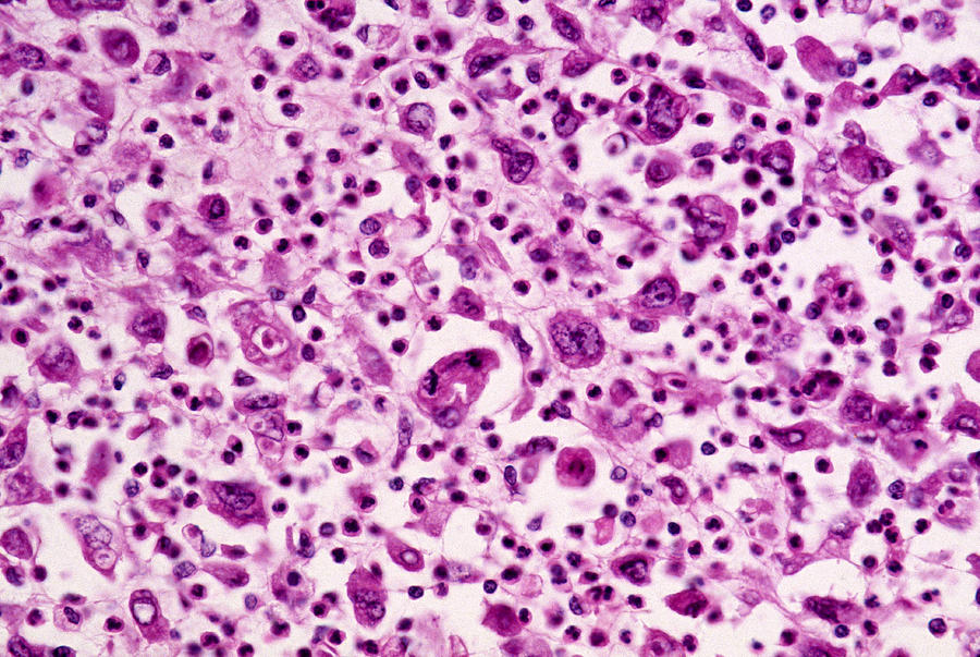 Giant-cell Carcinoma Of The Lung, Lm Photograph by Michael Abbey