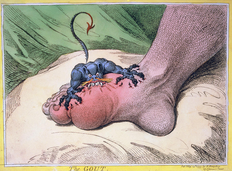 Gout Photograph - Gilray Cartoon Illustrating Gout In The Foot. by Jean-loup Charmet/science Photo Library