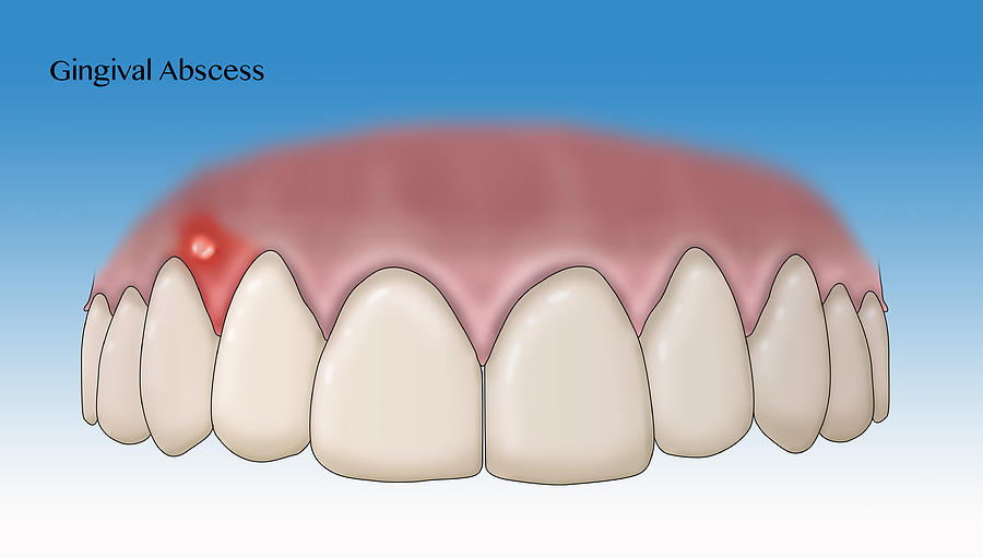 Gingival Abscess, Illustration Photograph by Monica Schroeder