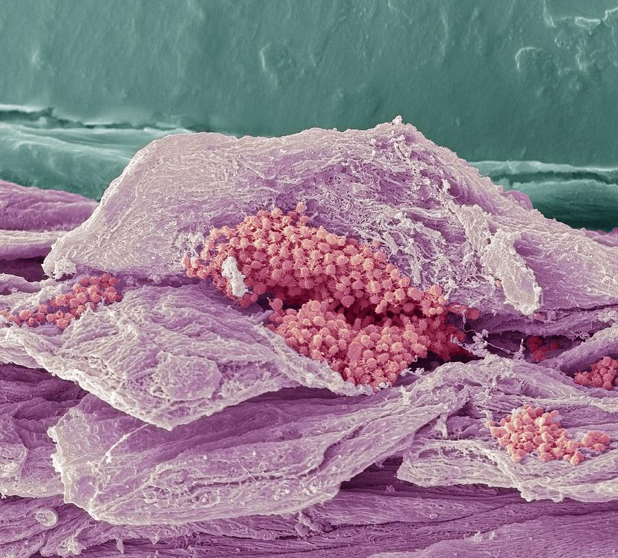 Abnormal Photograph - Gingivitis, SEM by Science Photo Library