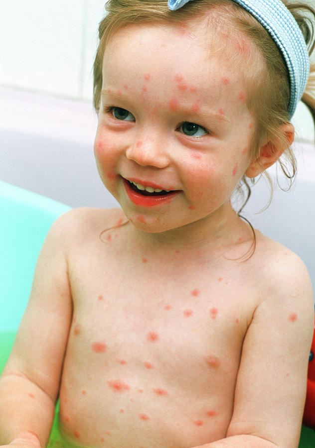 Girl With Chickenpox Photograph by Eamonn Mcnulty/science Photo Library ...