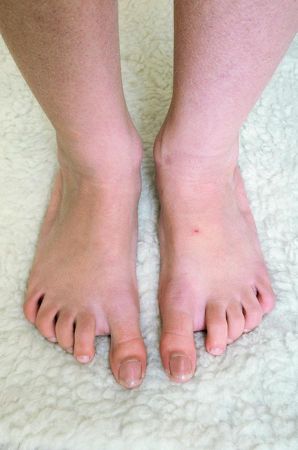 Girl With Growth Disorder Photograph by Science Photo Library