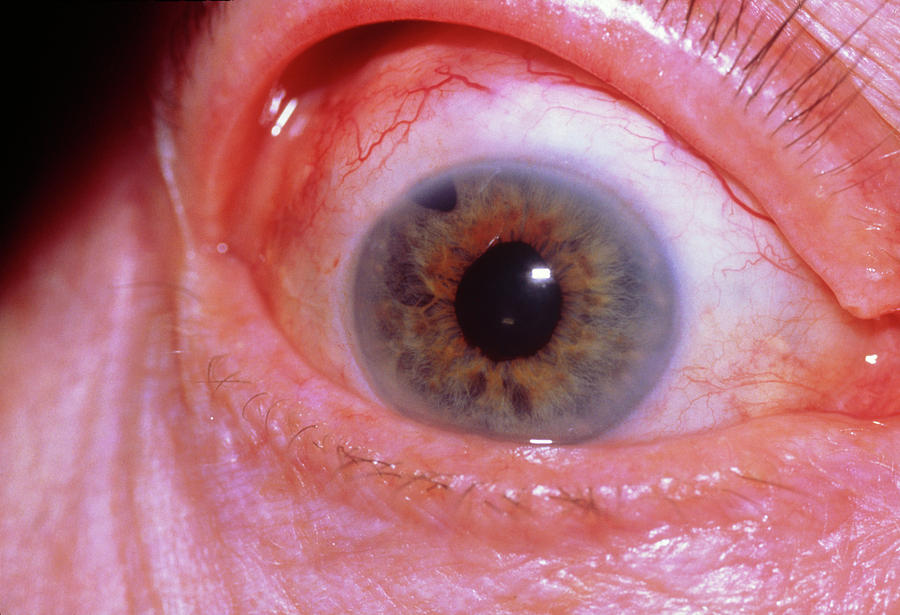 Glaucoma: Trabeculectomy Mark In Iris Photograph by Science Photo Library