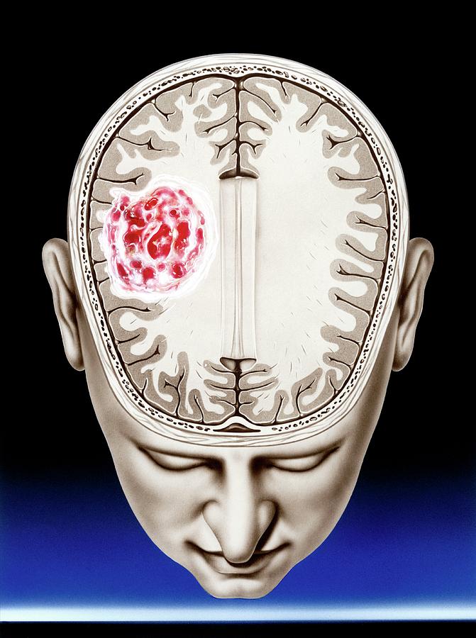 Glioma Brain Tumour Photograph by John Bavosi