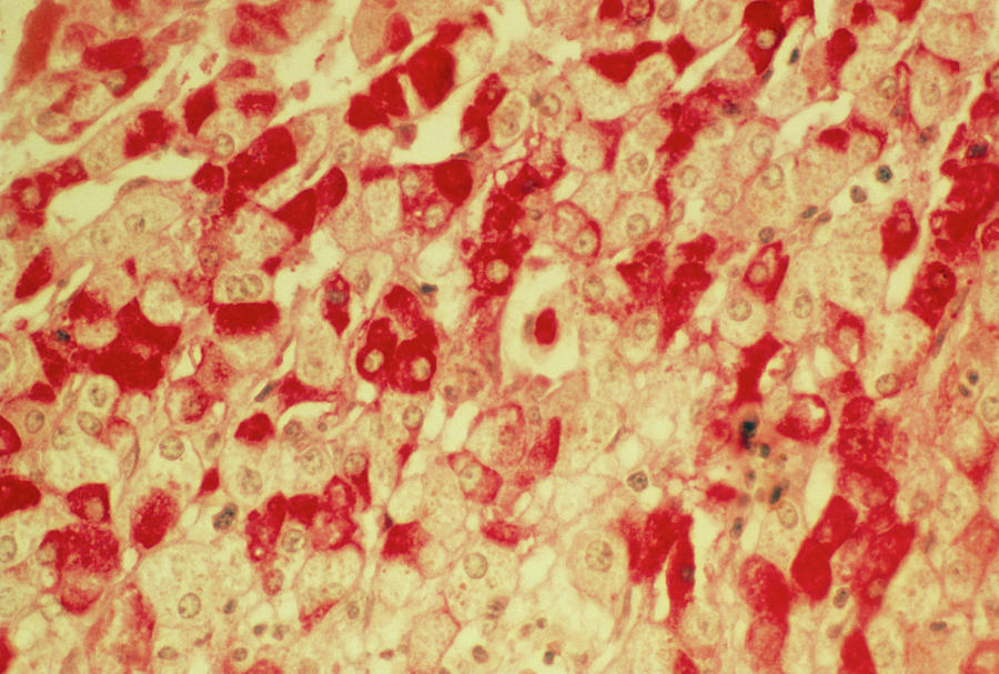 Glycogen In Liver Photograph by Science Photo Library