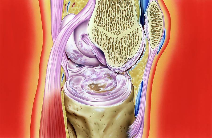 Gout In Knee Joint Photograph by John Bavosi