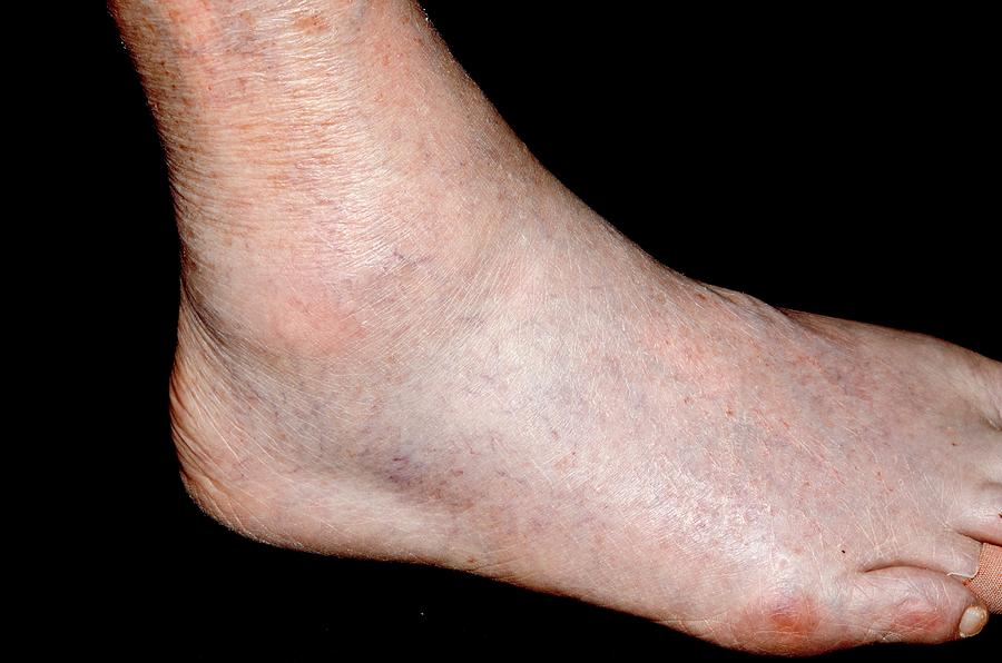 Gout In The Ankle Photograph by Dr P. Marazzi/science Photo Library