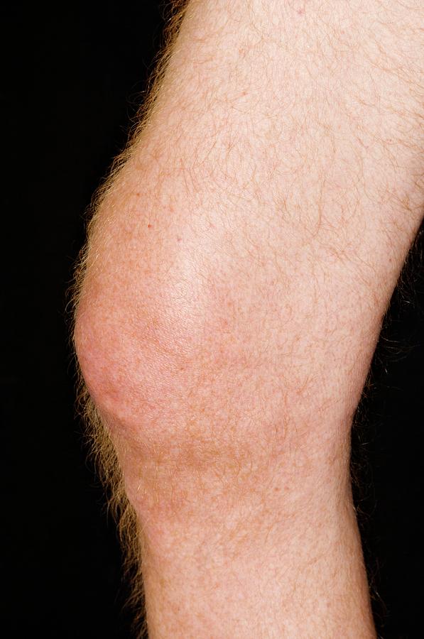 Gout In The Knee Photograph by Dr P. Marazzi/science Photo Library