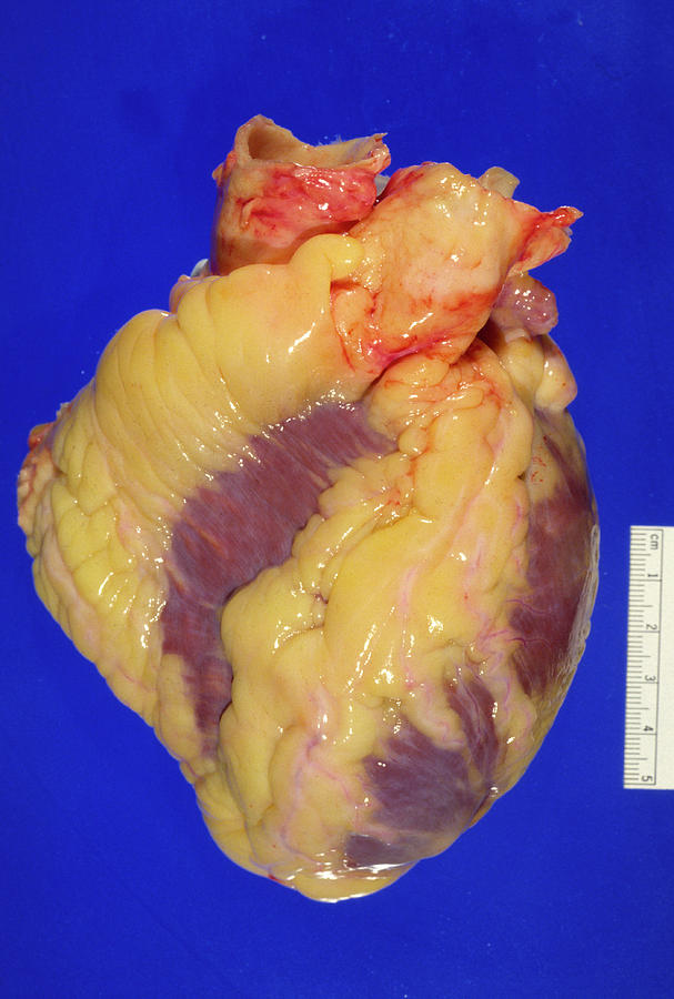 Gross Specimen Of A Healthy Human Heart Photograph by Science Photo Library