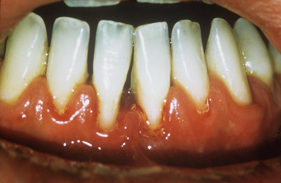 People Photograph - Gum Disease by Dr. J.p. Casteyde/cnri