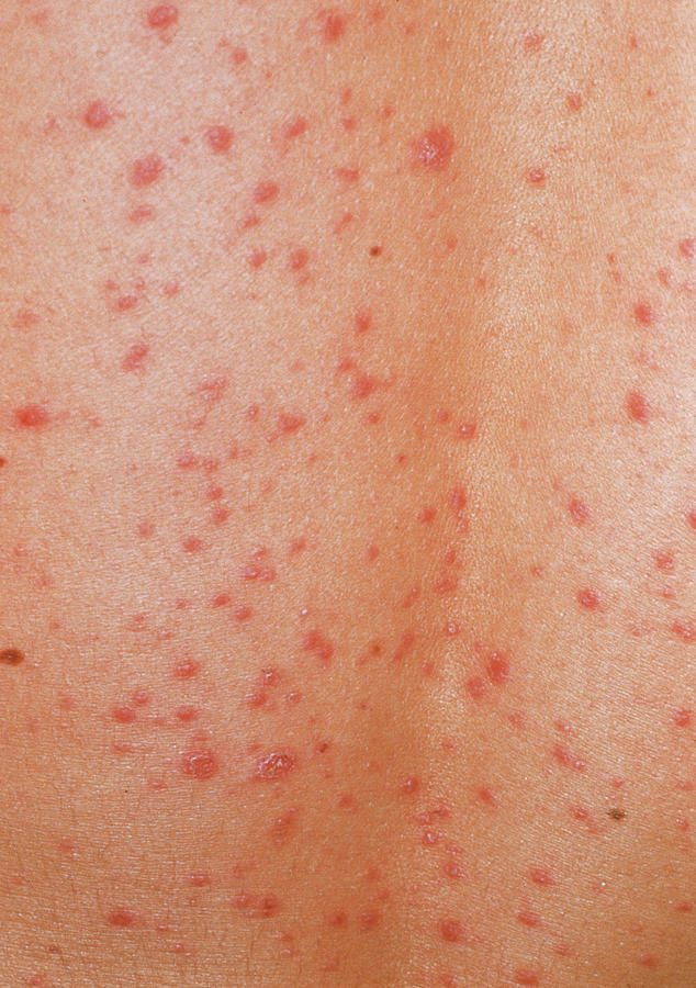 Guttate Psoriasis Skin Rash Photograph by Cnri/science