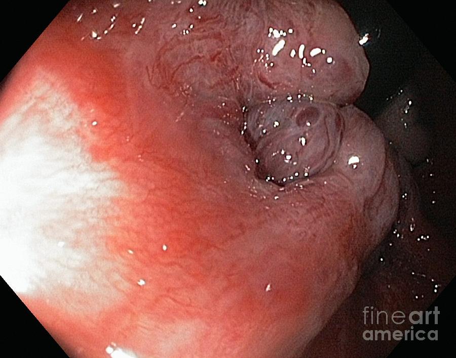 Digestive System Photograph - Haemorrhoids, Endoscopic View by Gastrolab