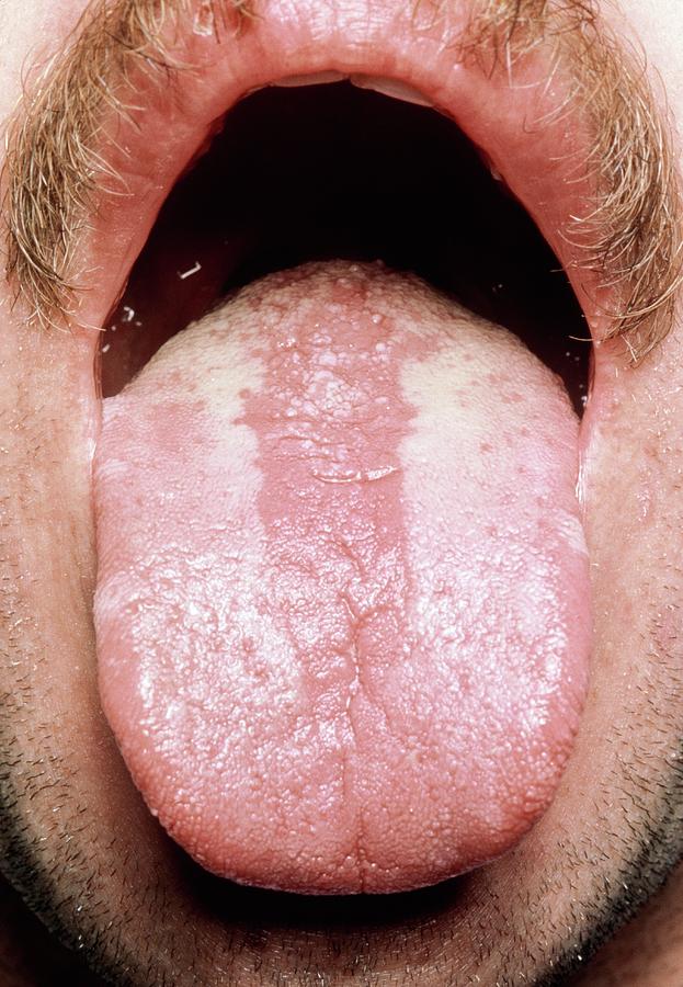 Hairy Leukoplakia And Candida On Tongue In Aids Photograph By Science