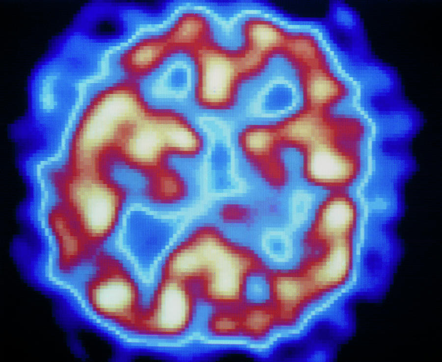 Brain Photograph - Hallucinating In Schizophrenia by Tim Beddow/science Photo Library