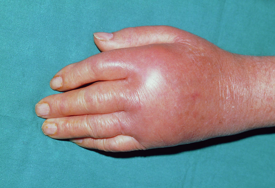 Hand Affected By Pseudogout Photograph by Dr P. Marazzi/science Photo ...