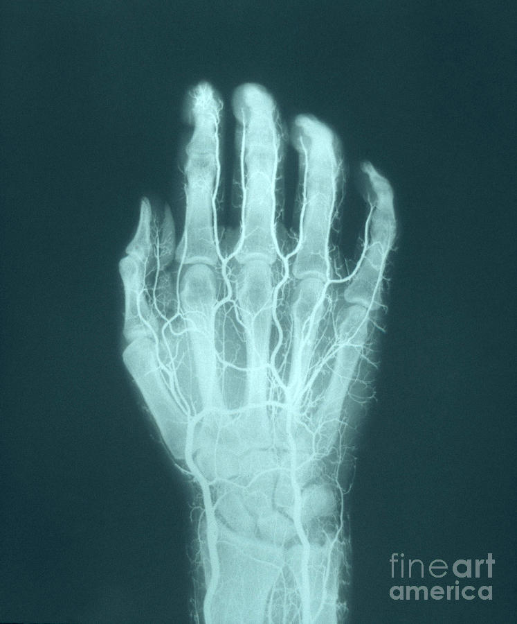 Hand Arteriogram Photograph by VideoSurgery