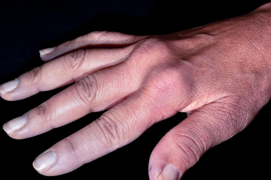 Hand In Crest Syndrome Photograph by Dr P. Marazzi/science Photo Library