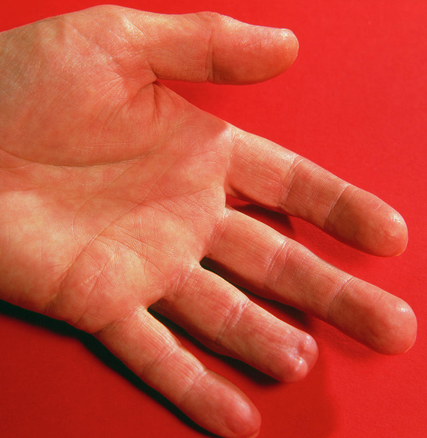 Hand With Top Of One Finger Cut Off Photograph By Sheila Terry science 