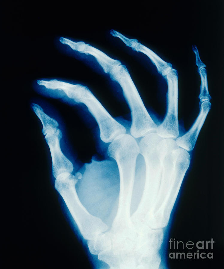 Hand X-ray Healthy Photograph by Erich Schrempp