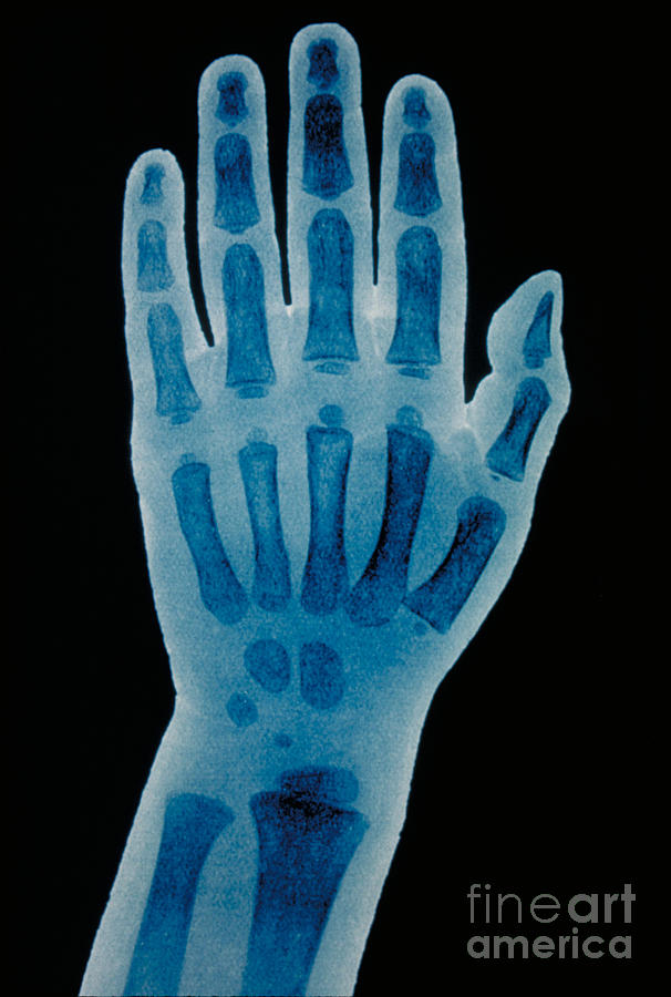 Hand X-ray Of A 2 Year Old Child Photograph by Scott Camazine & Sue Trainor