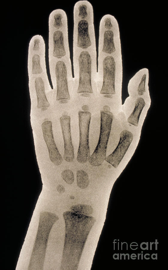 Hand X-ray Of A 2 Year Old Child Photograph by Scott Camazine