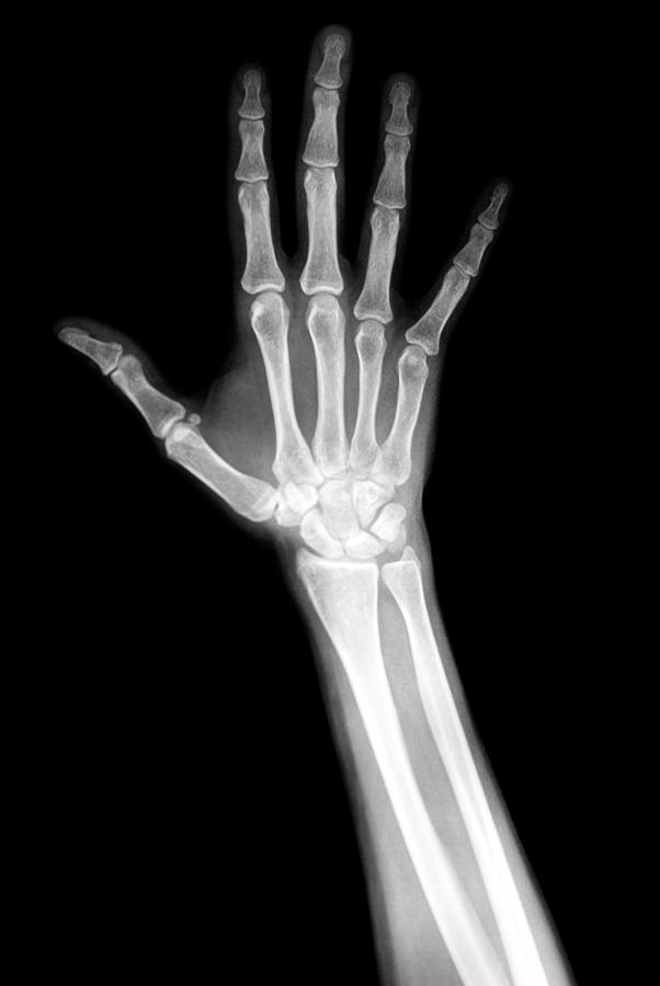 Hand X-Ray Photograph by Stevedangers