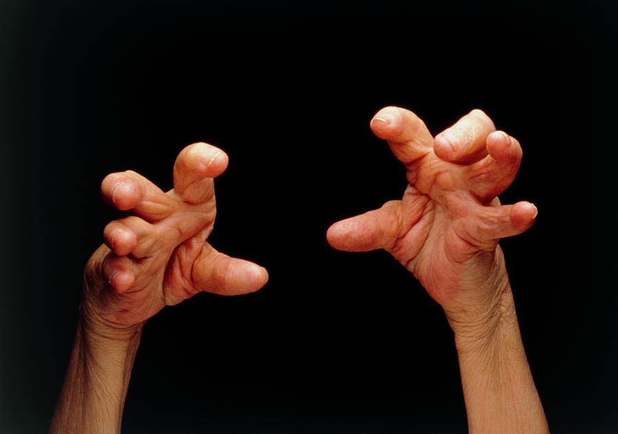 Hands Affected By Rheumatoid Arthritis Medical Photo Nhs Lothianscience Photo Library 