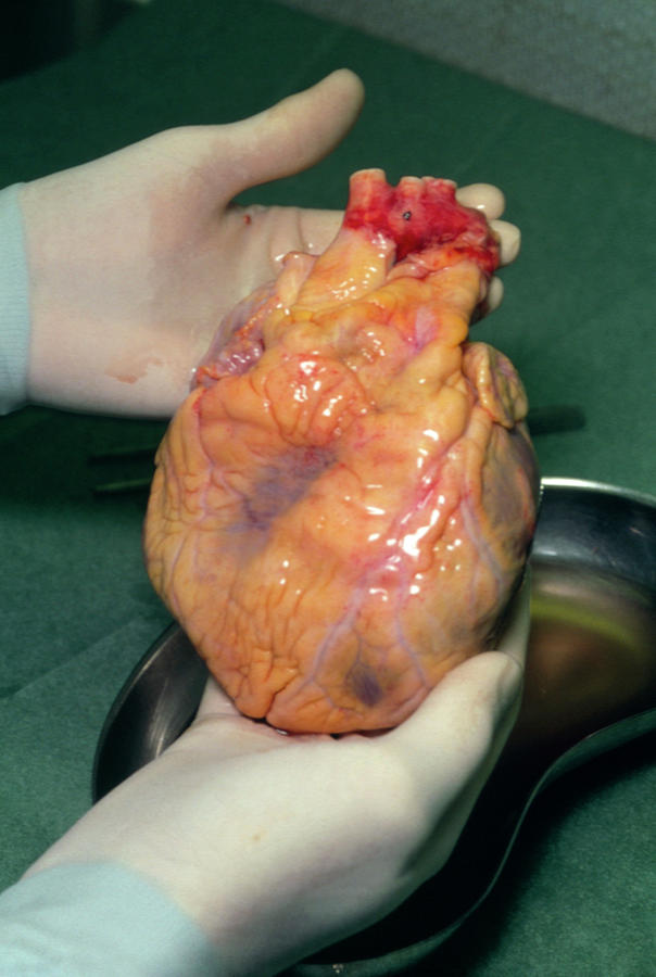 Hands Holding Freshly Removed Human Heart Photograph by Klaus Guldbrandsen/science Photo Library