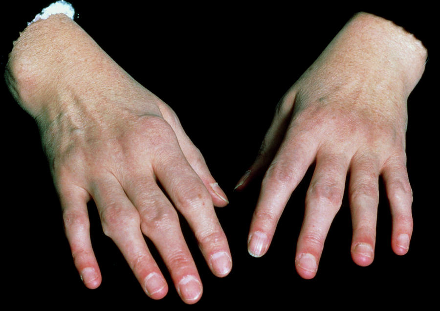 Hands Of A Patient With Rheumatoid Arthritis Sue Fordscience Photo Library 