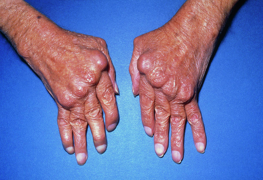 Hands With Rheumatoid Arthritis Photograph By James Stevenson science 