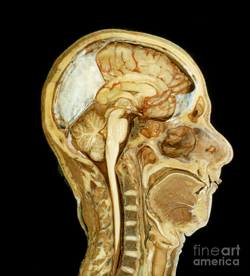 Head And Neck, Mid Sagittal Section Photograph by VideoSurgery