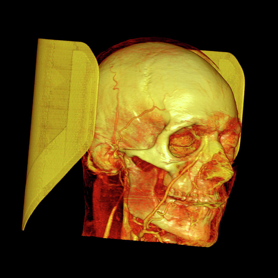 Skull Photograph - Head by Antoine Rosset/science Photo Library